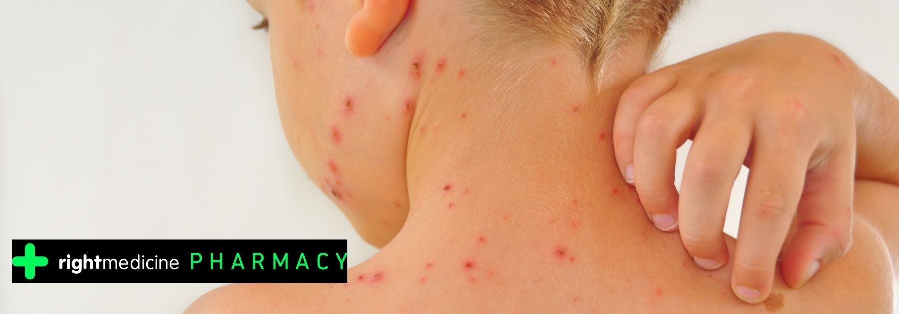 chickenpox
